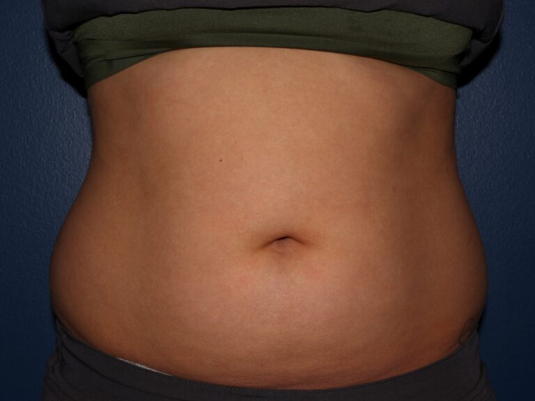 Before Image: CoolSculpting - front