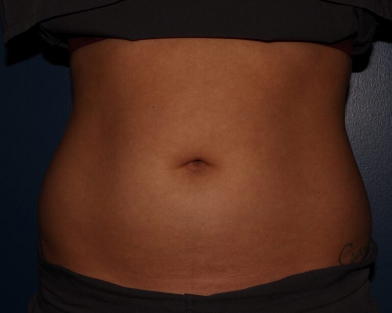 After Image: CoolSculpting - front