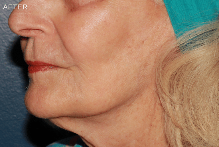 After Image: Secret RF / Filler / BBL - left-front-oblique