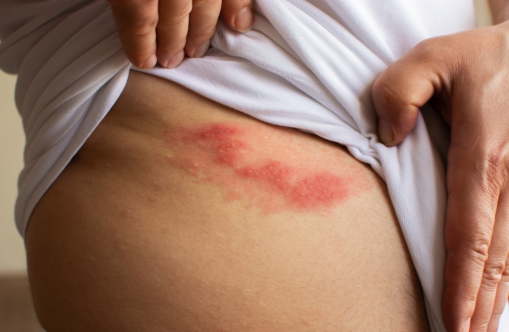 Man lifts his shirt to show shingles that have formed on one side of his ribcage. Vaccination can help prevent this