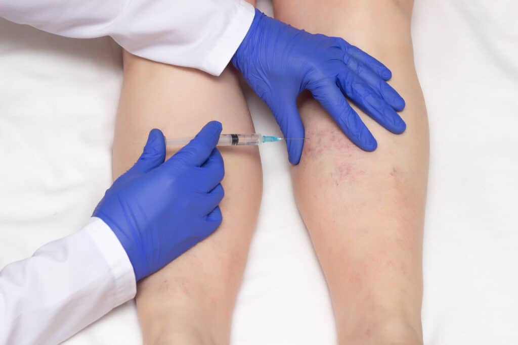 Close up of a doctor performing a sclerotherapy procedure on a patient's legs to get rid of spider veins