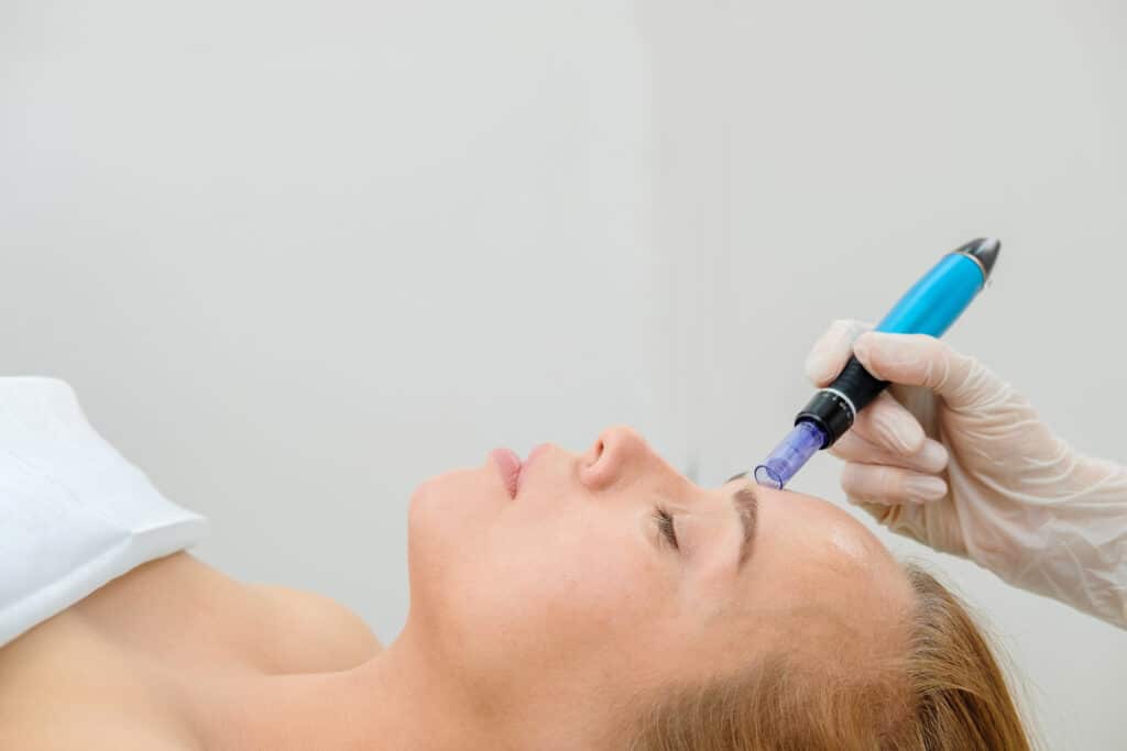 Close up of a woman having a microneedling treatment done in a spa-like setting
