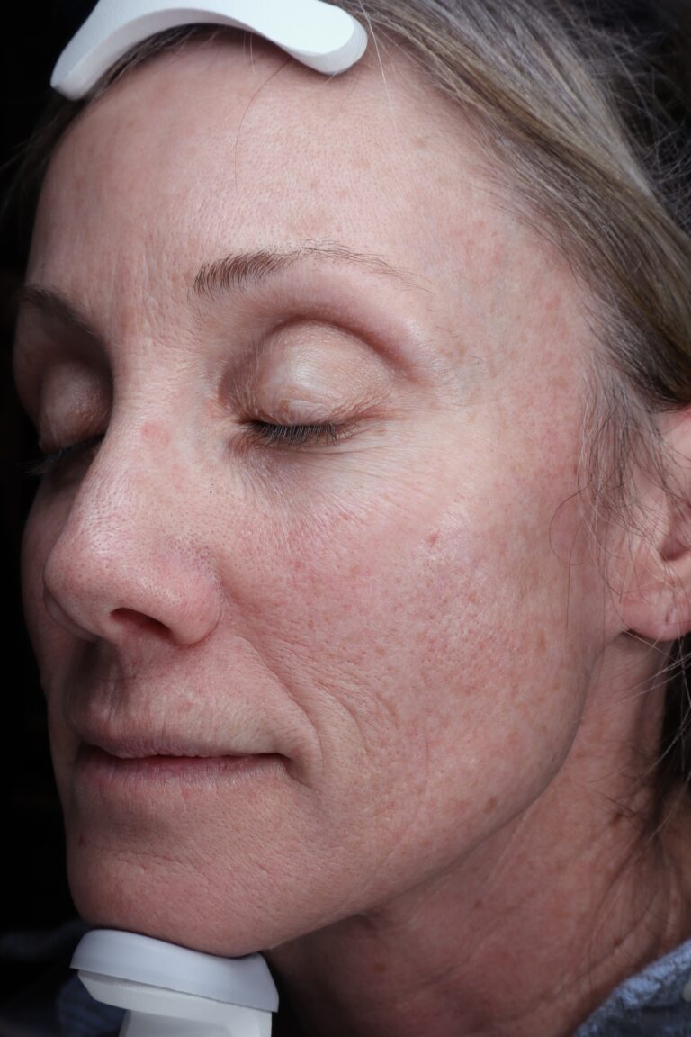 Before Image: CO2 Laser - left-side