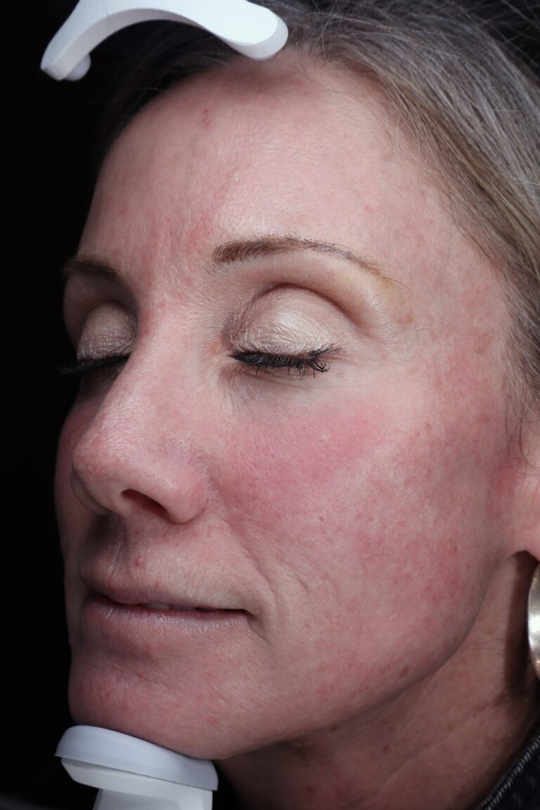 After Image: CO2 Laser - left-side