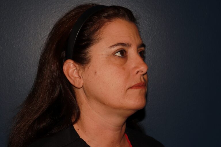 Before Image: HALO + Filler - right-side