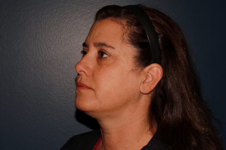 Before Image: HALO + Filler - left-side