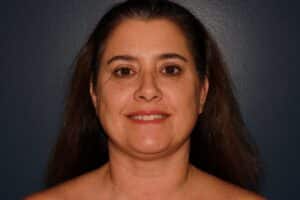 After Image: HALO + Filler