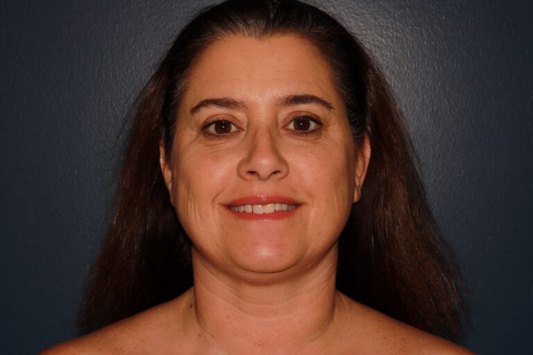 After Image: HALO + Filler - front