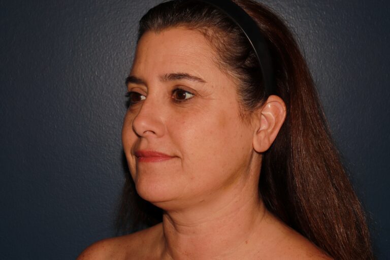 After Image: HALO + Filler - left-side