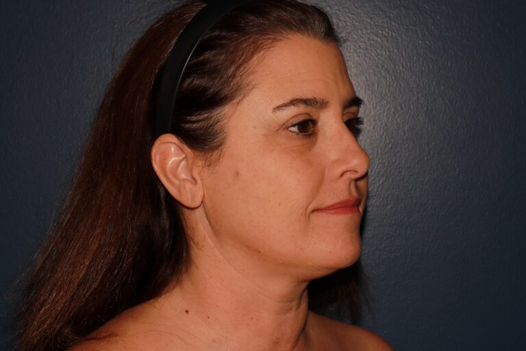 After Image: HALO + Filler - right-side