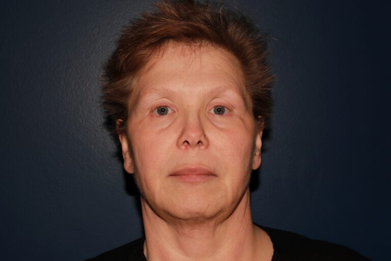 After Image: BBL + MOXI - front