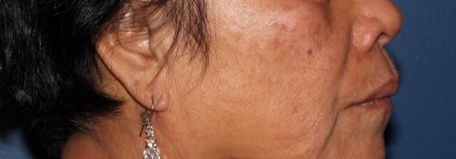 Before Image: BBL Laser for Brown Spots - right-side